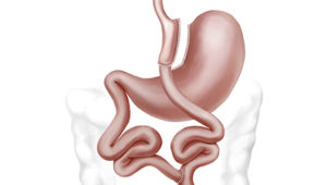 gastric_bypass