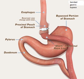 Banded Gastric Bypass