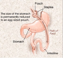 RNY-Gastric-Bypass